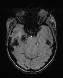 File:Cerebral cavernous venous malformation (Radiopaedia 70008-80021 I 24).jpg