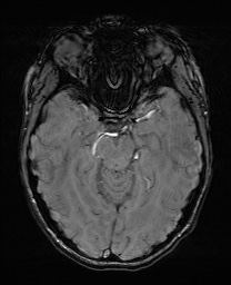 Cerebral cavernous venous malformation (Radiopaedia 70008-80021 I 28).jpg