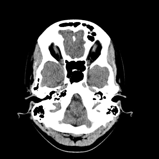 File:Cerebral cavernous venous malformation (Radiopaedia 70008-80022 Axial non-contrast 7).jpg
