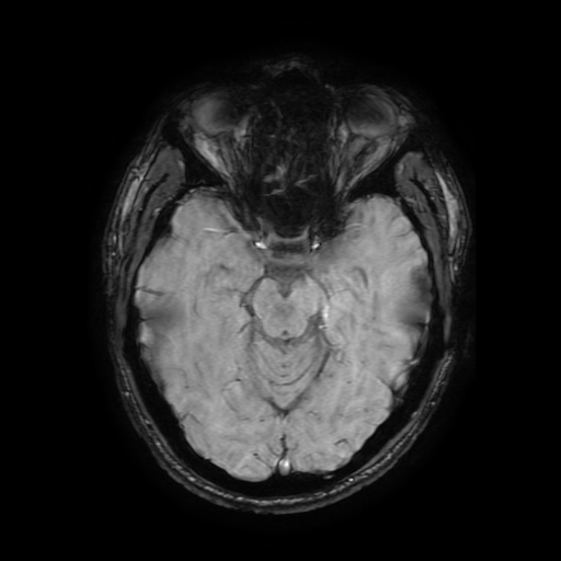 Cerebral cavernous venous malformation (Zabramski type II) (Radiopaedia 85511-101198 Axial SWI 52).jpg