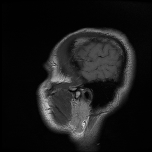 File:Cerebral cavernous venous malformation (Zabramski type II) (Radiopaedia 85511-101198 Sagittal T1 5).jpg