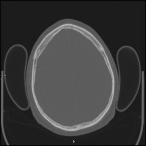 Cerebral contusions (Radiopaedia 33868-35039 Axial bone window 158).jpg