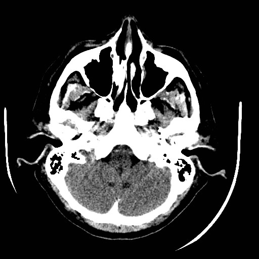 File:Cerebral edema (evolution in time) (Radiopaedia 19418-19440 non-contrast 19).jpg