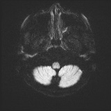 Cerebral embolic infarcts (embolic shower) (Radiopaedia 72391-82921 Axial DWI 33).jpg