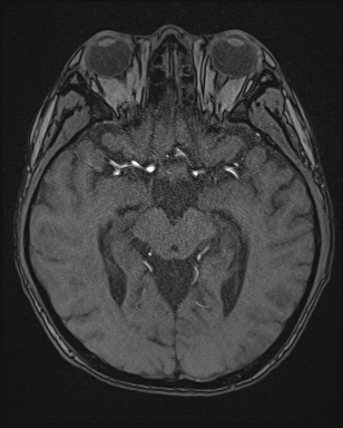 Cerebral embolic infarcts (embolic shower) (Radiopaedia 72391-82921 Axial MRA 70).jpg
