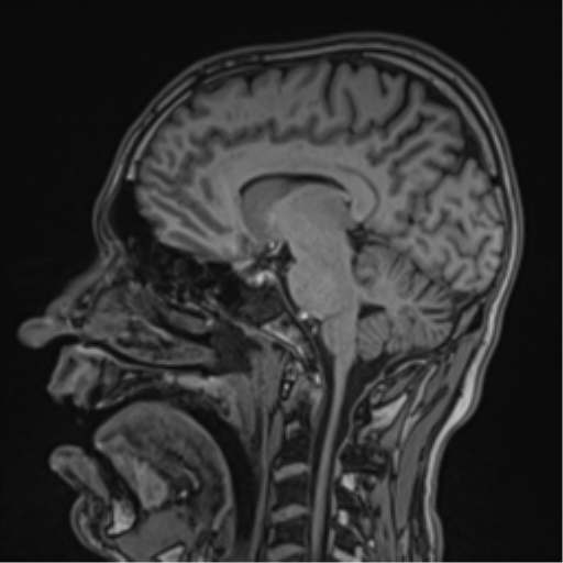 Cerebral fat embolism (Radiopaedia 57697-64639 Sagittal T1 25).png