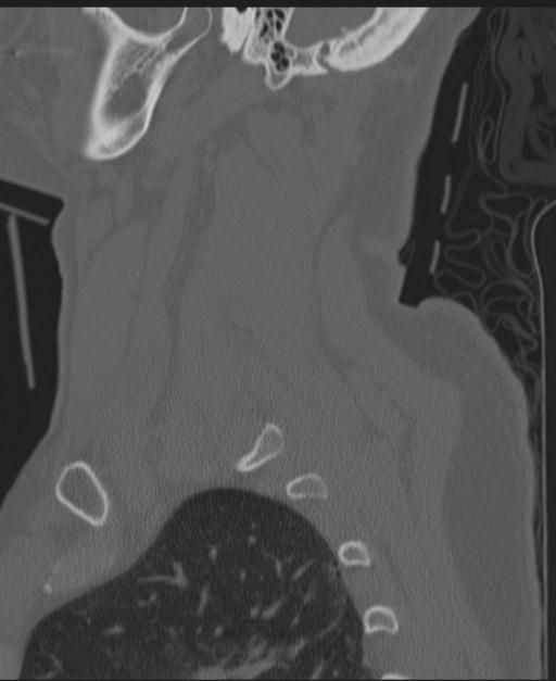 Cerebral hemorrhagic contusions and cervical spine fractures (Radiopaedia 32865-33841 Sagittal bone window 19).jpg