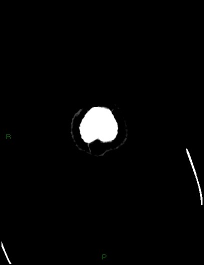 Cerebral metastases - ependymal and parenchymal (Radiopaedia 79877-93131 Axial C+ delayed 90).jpg