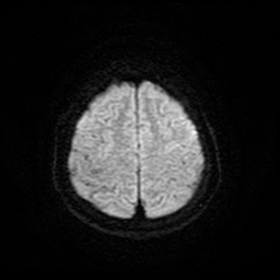 File:Cerebral metastases - melanoma (Radiopaedia 80972-94522 Axial DWI 24).jpg