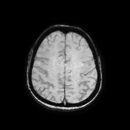 File:Cerebral metastases - melanoma (Radiopaedia 80972-94522 Axial SWI 72).jpg