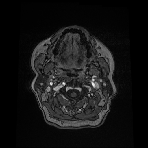 Cerebral metastases - melanoma (Radiopaedia 80972-94522 Axial T1 C+ 10).jpg