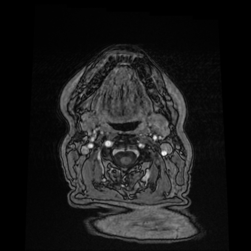 Cerebral metastases - melanoma (Radiopaedia 80972-94522 Axial T1 C+ 3).jpg
