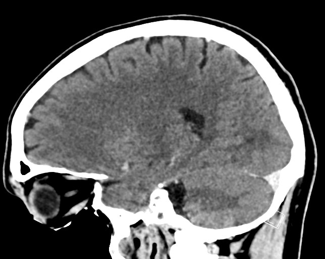 Cerebral metastases - testicular choriocarcinoma (Radiopaedia 84486-99855 F 37).jpg