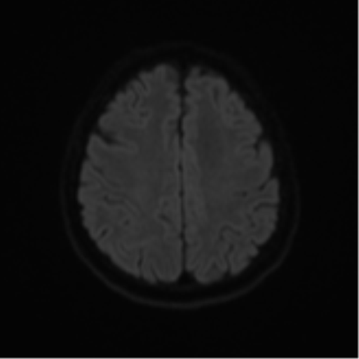 Cerebral metastases mimicking abscesses (Radiopaedia 45841-50131 Axial DWI 49).png