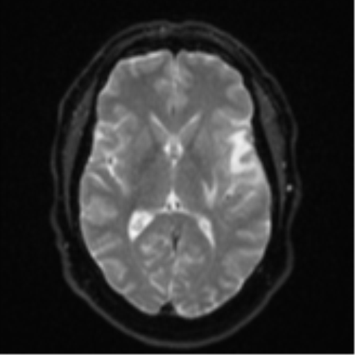 File:Cerebral metastases mimicking multifocal glioblastoma (Radiopaedia 50843-56353 Axial DWI 14).png