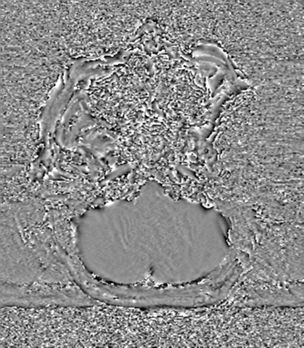 Cerebral metastasis to basal ganglia (Radiopaedia 81568-95413 Axial SWI phase 13).png
