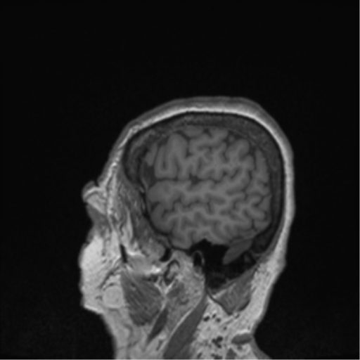 Cerebral metastasis to basal ganglia (Radiopaedia 81568-95413 Sagittal T1 7).png