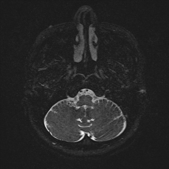 Cerebral ring enhancing lesions - cerebral metastases (Radiopaedia 44922-48817 F 8).jpg