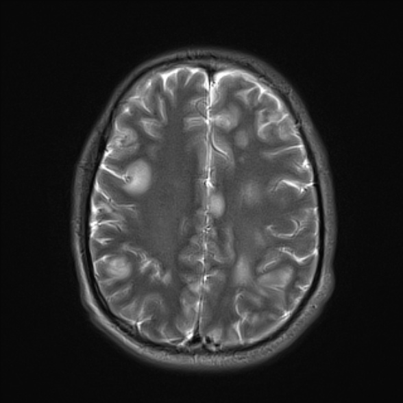 File:Cerebral toxoplasmosis (Radiopaedia 53993-60132 Axial T2 19).jpg