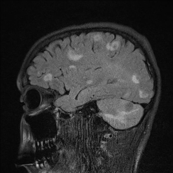 File:Cerebral toxoplasmosis (Radiopaedia 53993-60132 Sagittal FLAIR 9).jpg