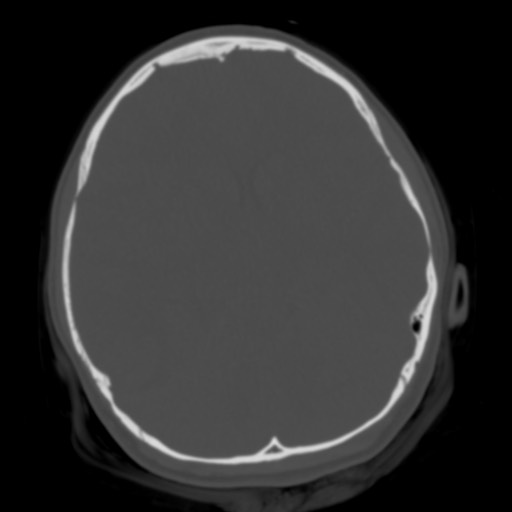 Cerebral tuberculosis with dural sinus invasion (Radiopaedia 60353-68018 Axial bone window 23).jpg