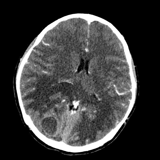 Cerebral tuberculosis with dural sinus invasion (Radiopaedia 60353-68019 Axial C+ delayed 35).jpg