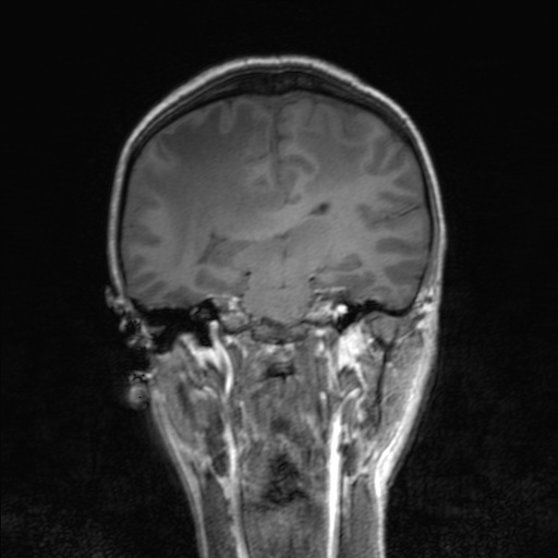 Cerebral tuberculosis with dural sinus invasion (Radiopaedia 60353-68090 Coronal T1 106).jpg