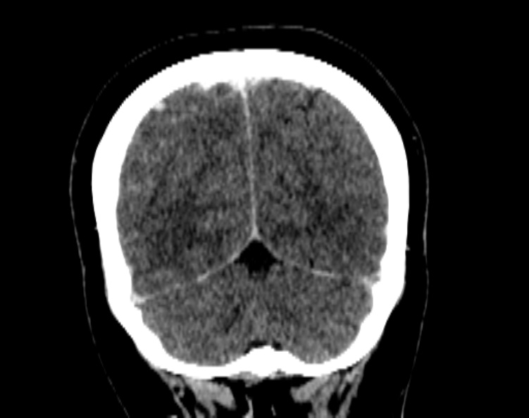 Cerebral venous hemorrhagic infarct from venous sinus thrombosis (Radiopaedia 55433-61883 Coronal C+ delayed 50).jpg