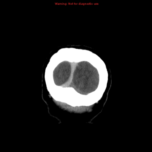 Cerebral venous infarction (Radiopaedia 12404-20735 B 79).jpg