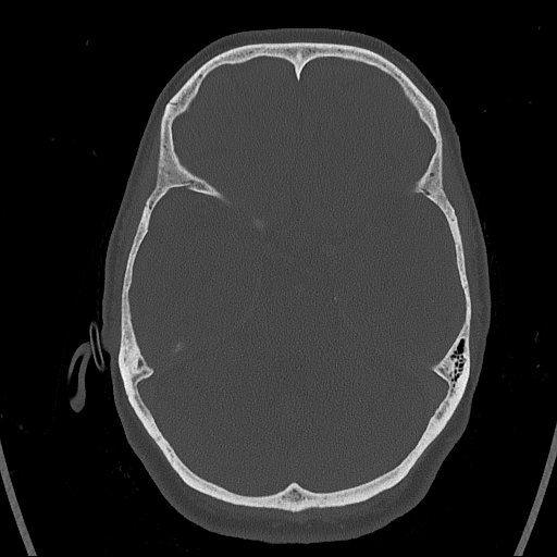 Cerebral venous infarction with hemorrhage (Radiopaedia 65343-74381 Axial bone window 51).jpg