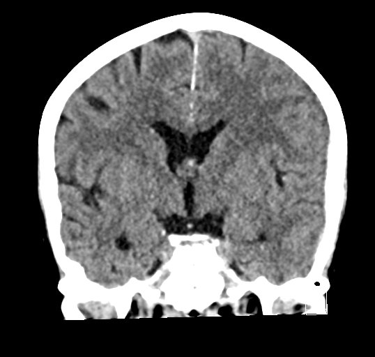 Cerebral venous infarction with hemorrhage (Radiopaedia 65343-74381 Coronal non-contrast 24).jpg