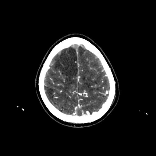 File:Cerebral venous throbmosis - hemorrhagic venous infarction (Radiopaedia 87318-103613 Axial CT venogram 33).jpg