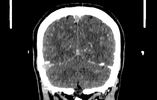 File:Cerebral venous thrombosis (CVT) (Radiopaedia 77524-89685 C 51).jpg