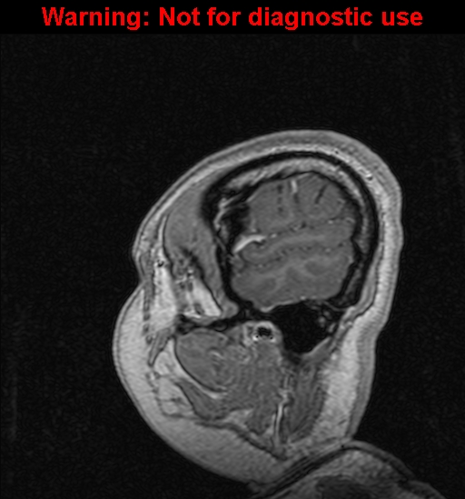 File:Cerebral venous thrombosis (Radiopaedia 37224-39208 Sagittal T1 C+ 17).jpg