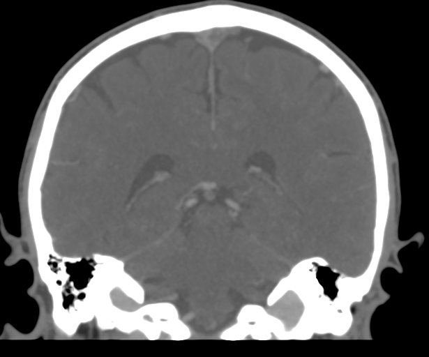 Cerebral venous thrombosis (Radiopaedia 38392-40467 Coronal CTA-Venogram 40).png