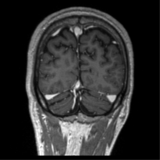 Cerebral venous thrombosis (Radiopaedia 38392-40469 Coronal T1 C+ 14).png