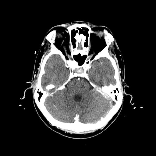 File:Cerebral venous thrombosis with venous hemorrhagic infarct (Radiopaedia 90354-107660 Axial with contrast 53).jpg
