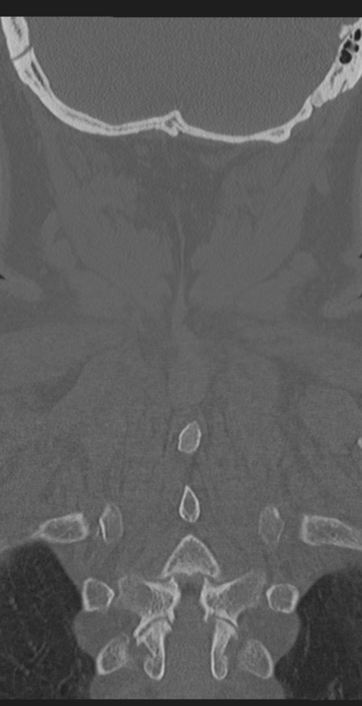 Cervical canal stenosis due to ossification of the posterior longitudinal ligament (Radiopaedia 47260-51823 Coronal bone window 56).png