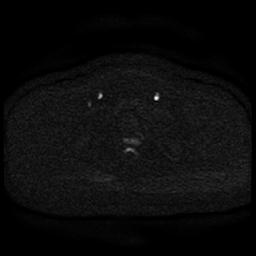 Cervical carcinoma (Radiopaedia 85405-101028 Axial DWI 64).jpg