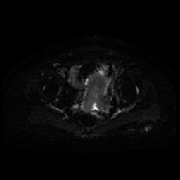 Cervical carcinoma (Radiopaedia 85405-101028 Axial DWI 9).jpg
