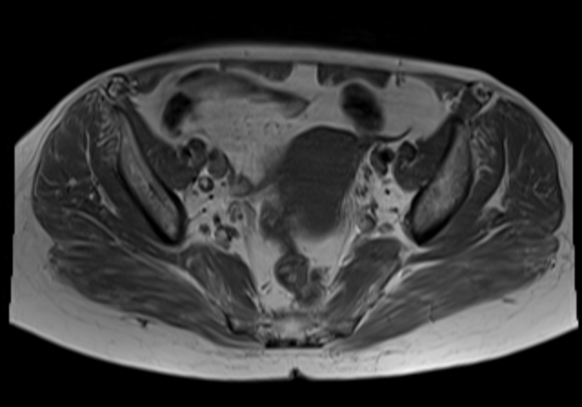 File:Cervical carcinoma (Radiopaedia 88312-104943 Axial T1 10).jpg