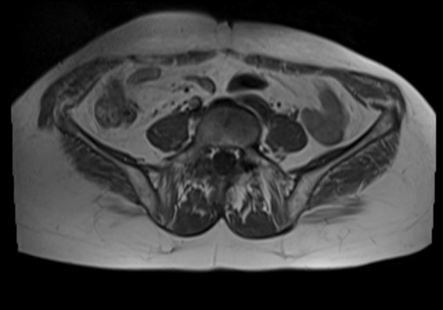 File:Cervical carcinoma (Radiopaedia 88312-104943 Axial T1 2).jpg