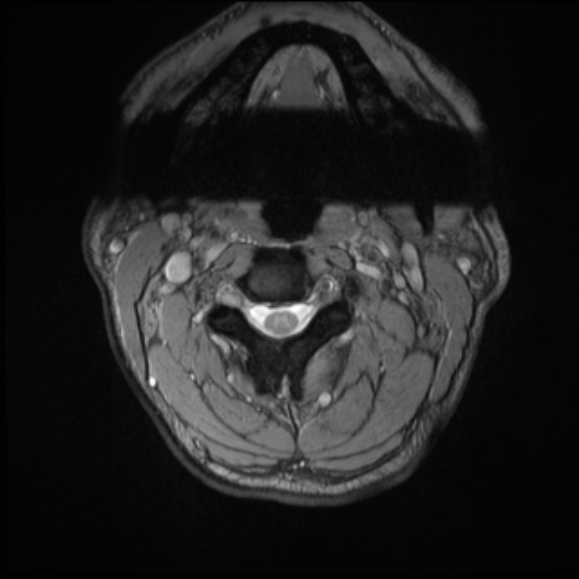 File:Cervical disc extrusion (Radiopaedia 53950-60077 Axial T2 5).jpg