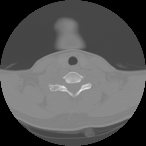 Cervical rib (Radiopaedia 71110-81363 Axial non-contrast 41).jpg