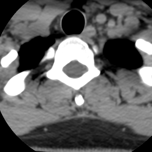 Cervical schwannoma (Radiopaedia 57979-64974 Axial non-contrast 60).png