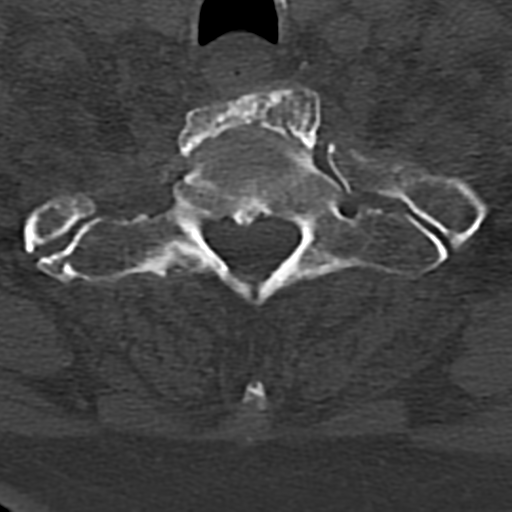 Cervical spine fracture - chalk stick (Radiopaedia 39116-41323 Axial bone window 79).png