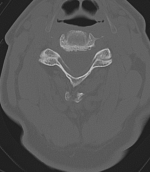 File:Cervical spine fractures with vertebral artery dissection (Radiopaedia 53296-59268 Axial bone window 25).png