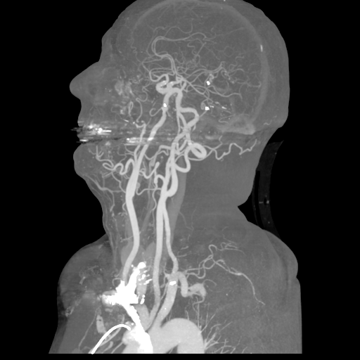 File:Cervical spine fractures with vertebral artery dissection (Radiopaedia 53296-59269 3D MIP 21).png