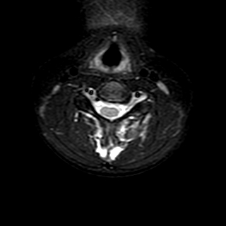 File:Cervical spine posterior ligamentous complex rupture (Radiopaedia 63486-72103 Axial T2 12).jpg