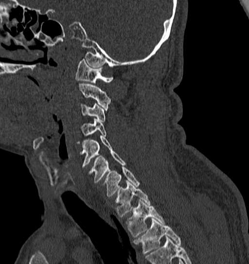 Cervical spine trauma with tear drop fracture and perched facet joint (Radiopaedia 53989-60127 Sagittal bone window 49).jpg
